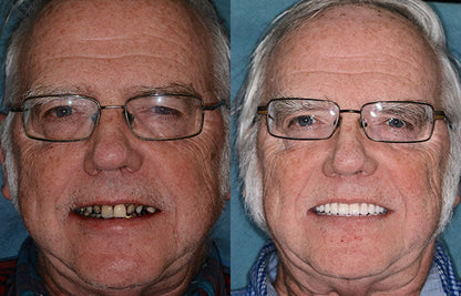 OFFICIAL STORE: Seurico™ - 🦷 Custom-Fit Full Denture Set for Natural Comfort 🦷