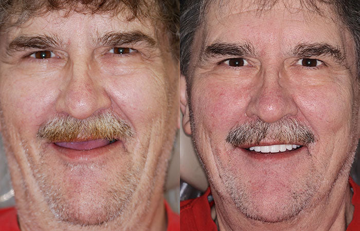 OFFICIAL STORE: Seurico™ - 🦷 Custom-Fit Full Denture Set for Natural Comfort 🦷