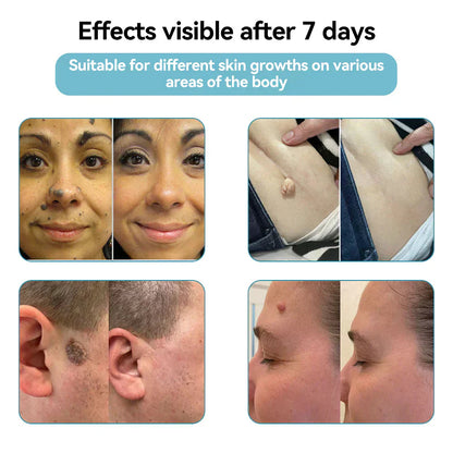 Seurico™ VelvetSkin+ Laser Eraser Pen | Non-Invasive Removal for Moles & Warts