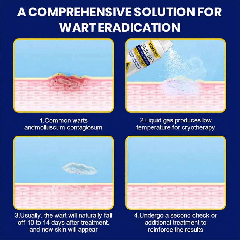 ❄️ ODALIT®: The Dermatologist-Grade Spray That Freezes Away Skin Tags & Warts.