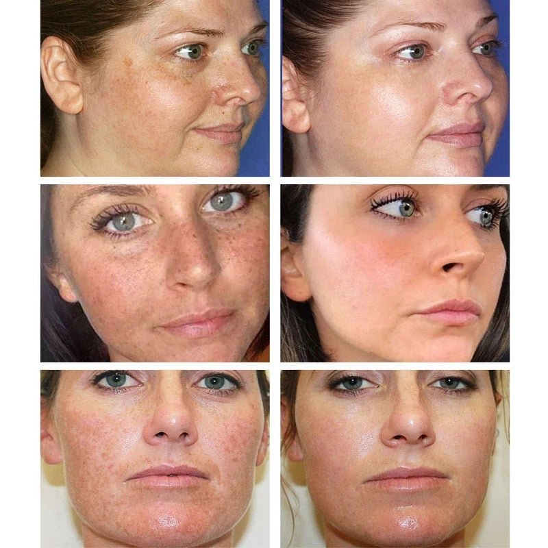 ✨ [Official Store] LBMLBM™ Blemish Removing Beauty Cream – Fade Dark Spots, Freckles & Wrinkles 💫 Restore a Radiant, Even-Toned Glow!