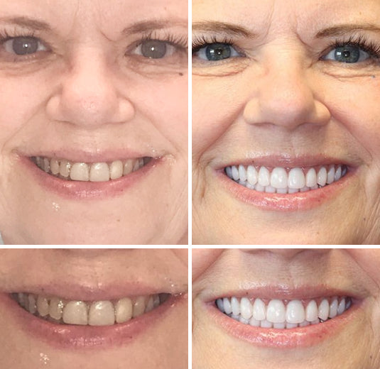 OFFICIAL STORE: Seurico™ - 🦷 Custom-Fit Full Denture Set for Natural Comfort 🦷