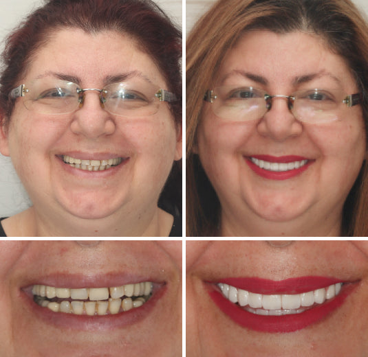 OFFICIAL STORE: Seurico™ - 🦷 Custom-Fit Full Denture Set for Natural Comfort 🦷