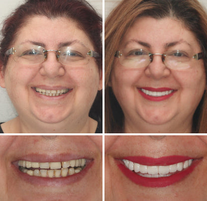 OFFICIAL STORE: Seurico™ - 🦷 Custom-Fit Full Denture Set for Natural Comfort 🦷
