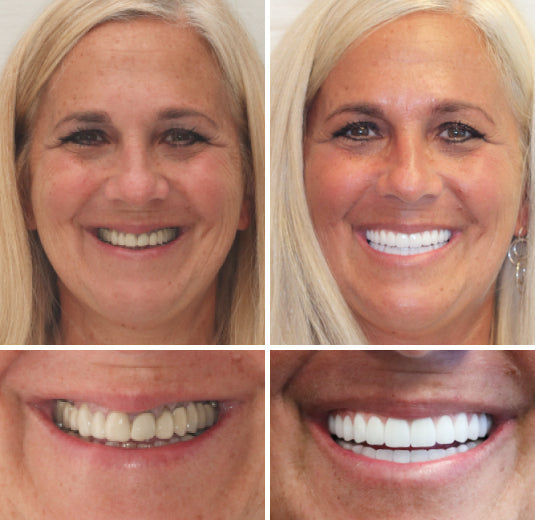 OFFICIAL STORE: Seurico™ - 🦷 Custom-Fit Full Denture Set for Natural Comfort 🦷