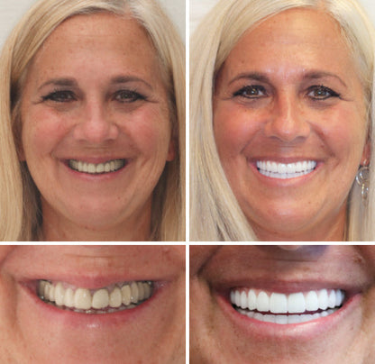 OFFICIAL STORE: Seurico™ - 🦷 Custom-Fit Full Denture Set for Natural Comfort 🦷